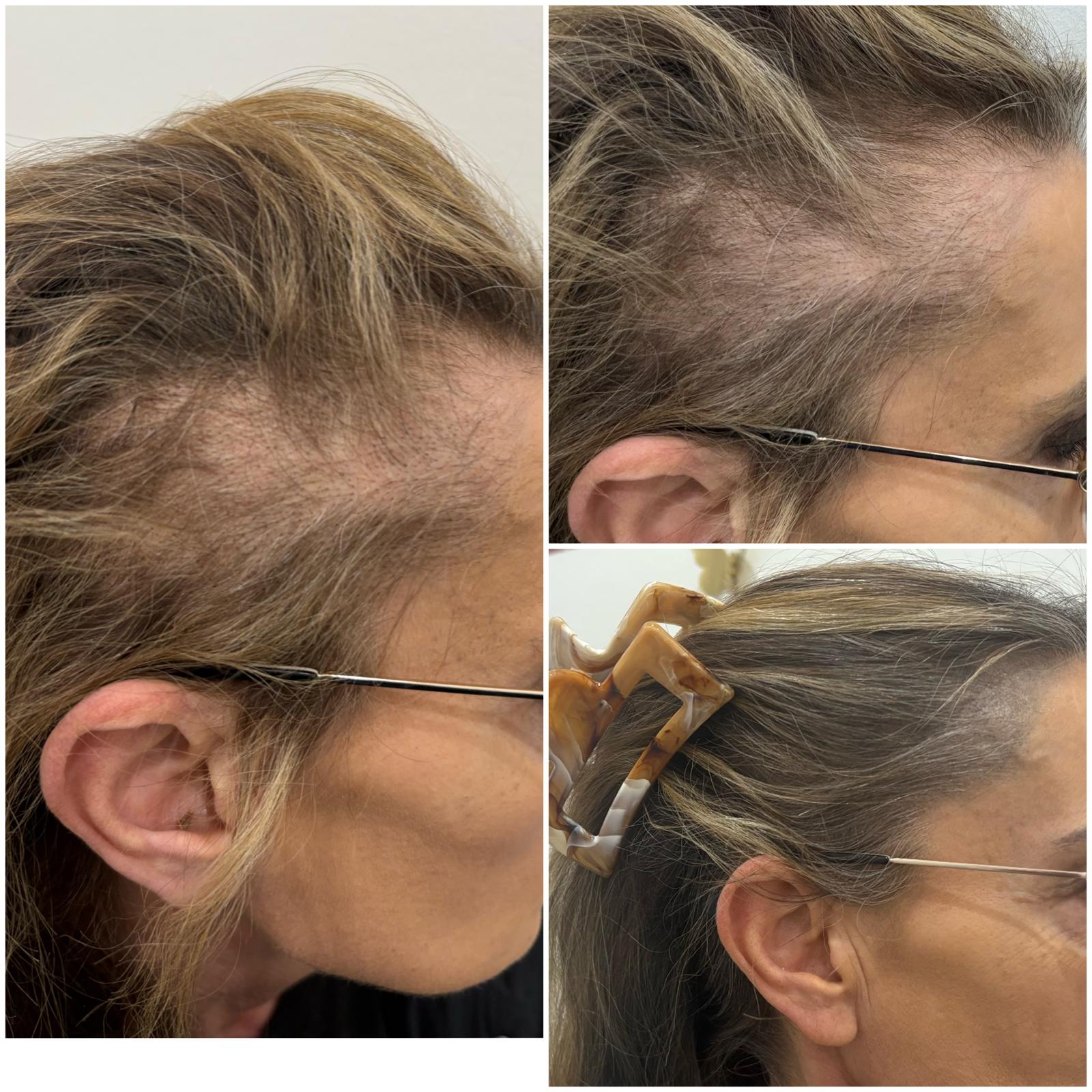 Women Density SMP 12-min